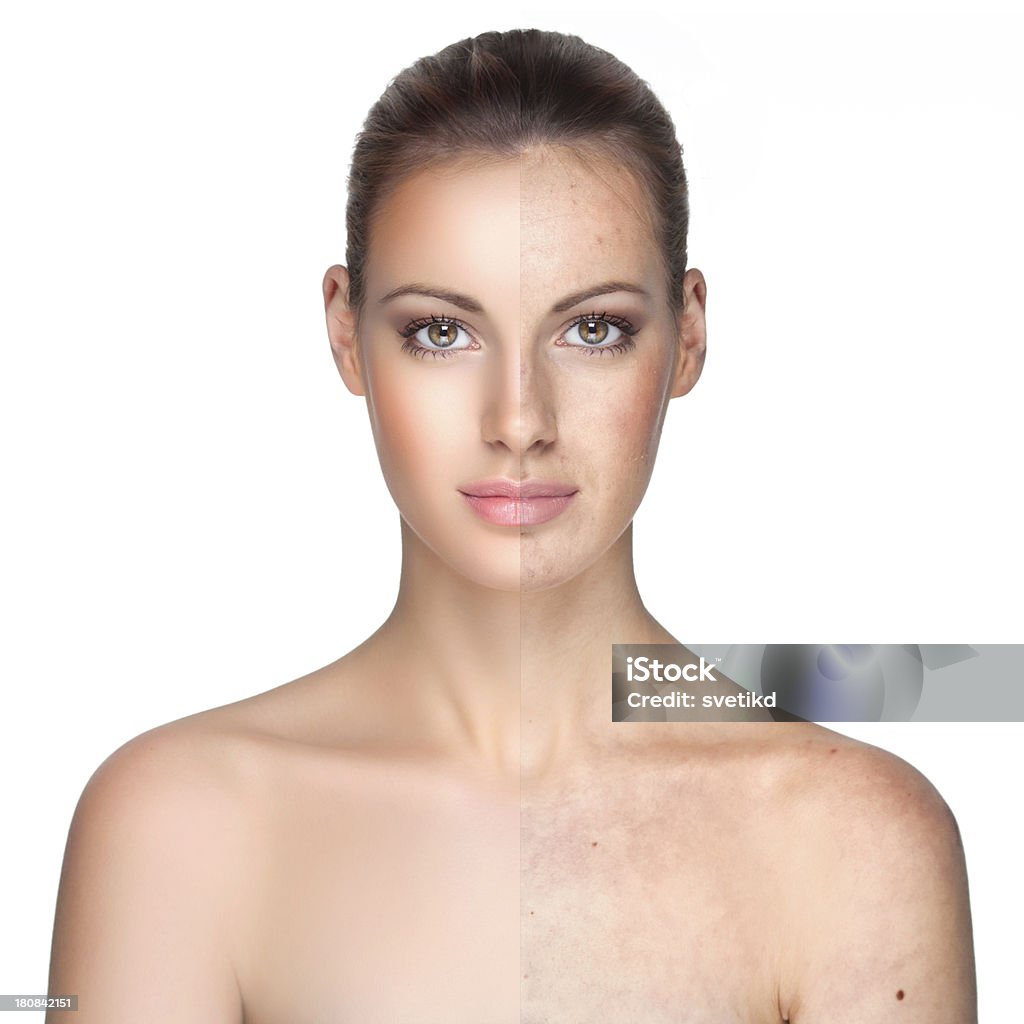 Before and after. Woman face divided in two parts - bad retouch to show acne and skin imperfections and beauty retouch.Check out a new MODEL. For lightbox click any image below. Before and After Stock Photo