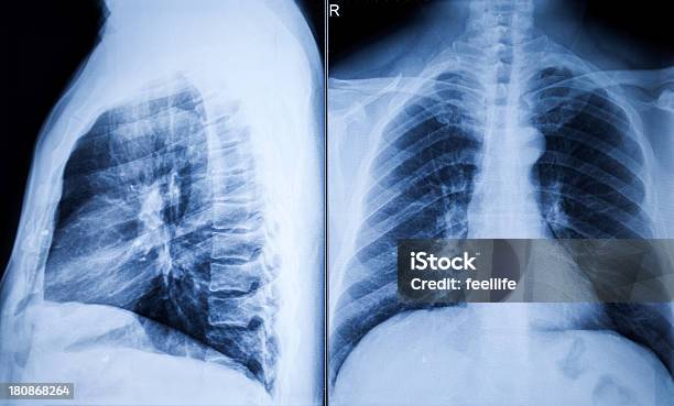 Uomo Radiografie Del Torace - Fotografie stock e altre immagini di BroncoPneumopatia Cronica Ostruttiva - BroncoPneumopatia Cronica Ostruttiva, Rullino, Torace umano