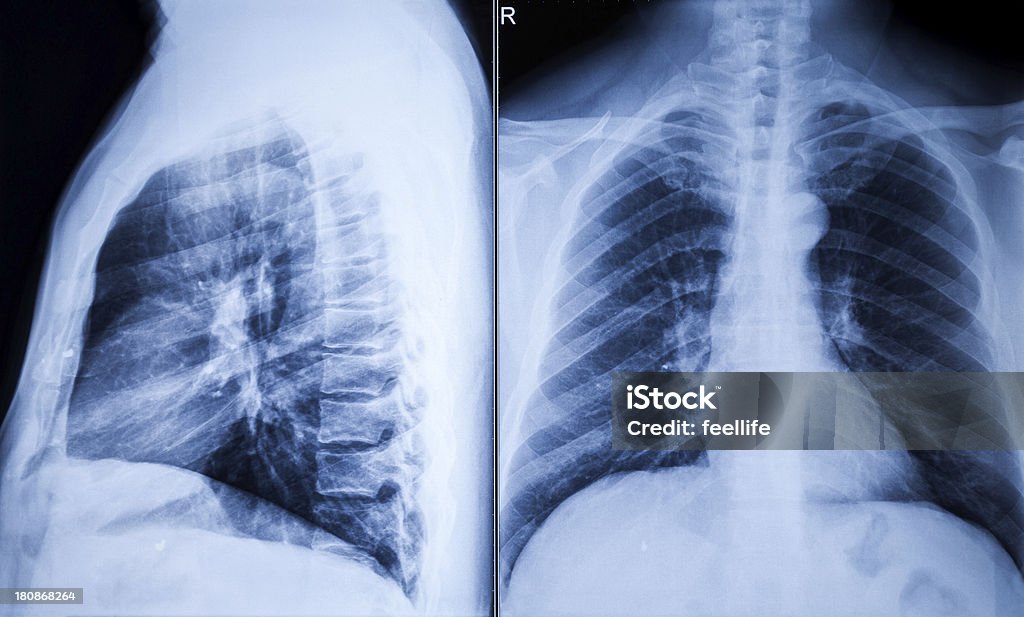 man 胸 xray - 写真フィルムのロイヤリティフリーストックフォト