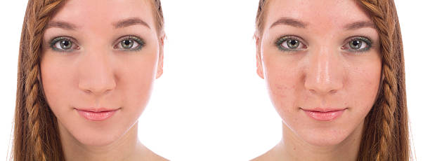 Close-up of teenager face with and without acne stock photo