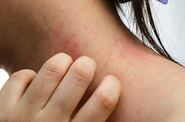 egzema skin na karku - eczema human neck toxicodermatitis close up zdjęcia i obrazy z banku zdjęć