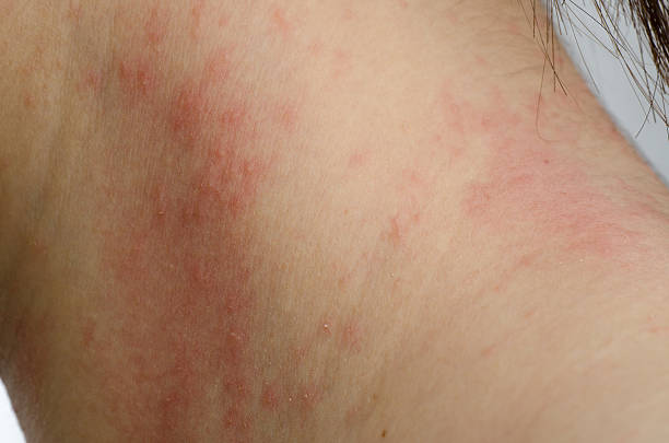 istock eczema skin on neck 180939063