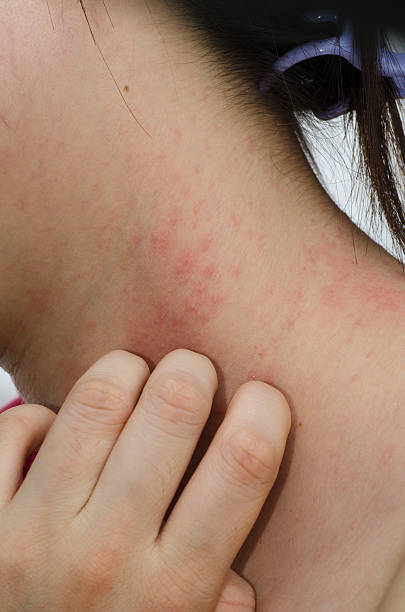 egzema skin na karku - eczema human neck toxicodermatitis close up zdjęcia i obrazy z banku zdjęć