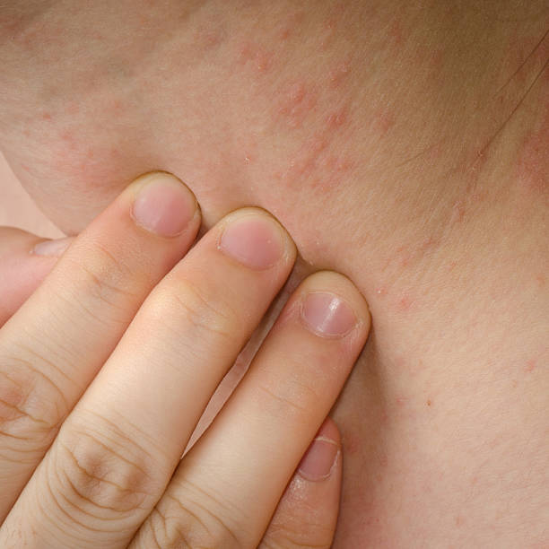 Кожаный дерматит фото у взрослых Кожаный дерматит фото у взрослых