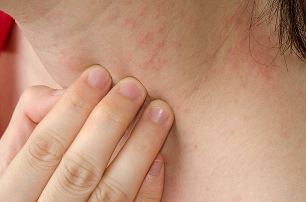 egzema skin na karku - eczema human neck toxicodermatitis close up zdjęcia i obrazy z banku zdjęć