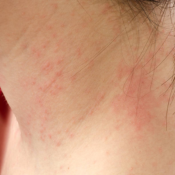 egzema skin na karku - eczema human neck toxicodermatitis close up zdjęcia i obrazy z banku zdjęć