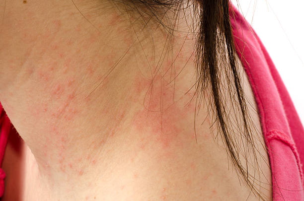 egzema skin na karku - eczema human neck toxicodermatitis close up zdjęcia i obrazy z banku zdjęć