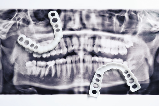 Mouth guards on dental scan, flat lay. Bite correction