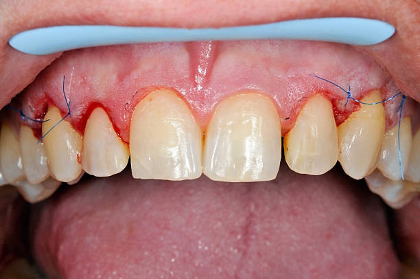 Gingivoplasty procedure Gingivoplasty procedure . Selective focus.You can find more dental related images like this one here : gingivoplasty stock pictures, royalty-free photos & images