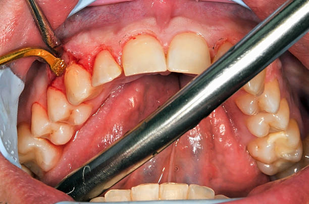 Gingivoplasty procedure Gingivoplasty procedure . Selective focus.You can find more dental related images like this one here : gingivoplasty stock pictures, royalty-free photos & images