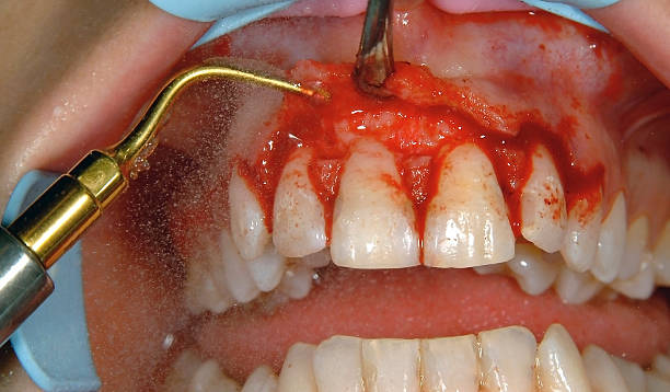 Gingivoplasty procedure Gingivoplasty procedure . Selective focus. gingivoplasty stock pictures, royalty-free photos & images