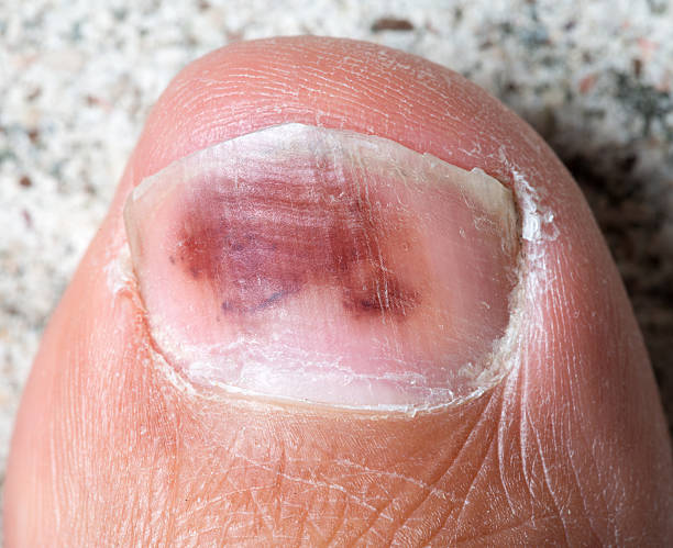 dedo grande hallux hematoma, equimose - fungus toenail human foot onychomycosis imagens e fotografias de stock