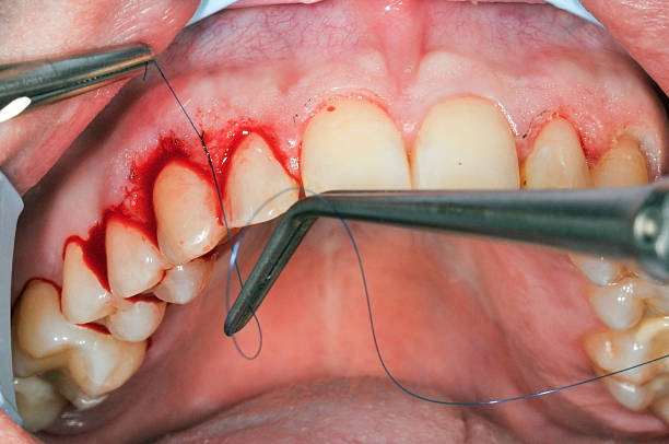 Gingivoplasty procedure Gingivoplasty procedure . Selective focus.You can find more dental related images like this one here : gingivoplasty stock pictures, royalty-free photos & images
