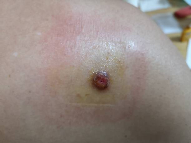 istock Man show lesion or wound on his shoulder after accident 1810706753