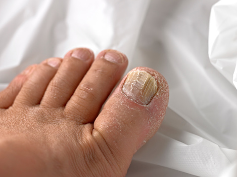 Toenail infected with Fungus.