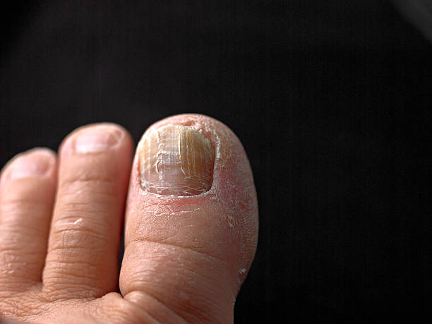 istock Toenail with Fungus 181077927