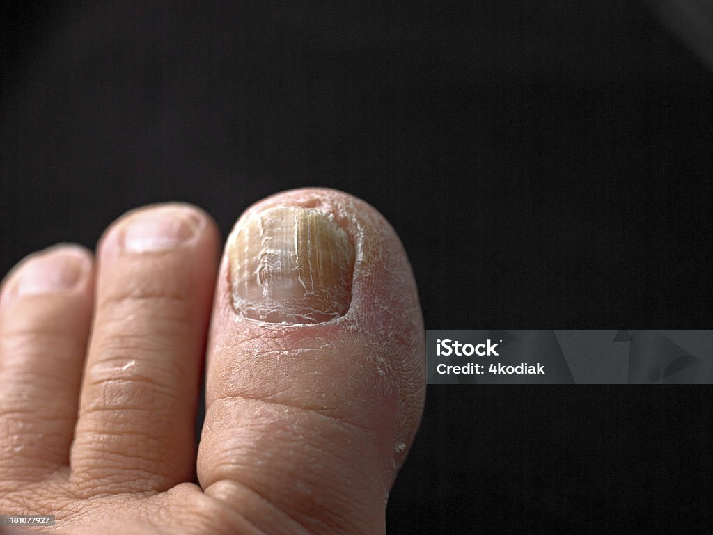 Paznokieć u nogi z Fungus - Zbiór zdjęć royalty-free (Grzybica paznokci)