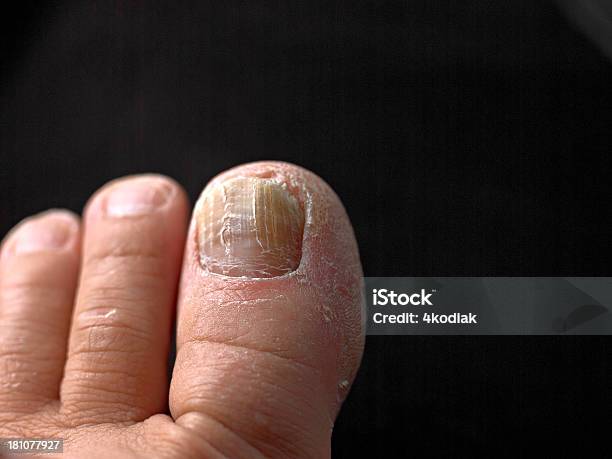 Paznokieć U Nogi Z Fungus - zdjęcia stockowe i więcej obrazów Grzybica paznokci - Grzybica paznokci, Brzydota, Choroba