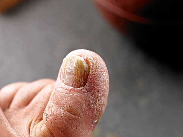 istock Toenail with Fungus 181080332