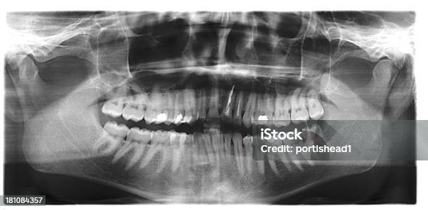 Zdjęcie Rentgenowskie - zdjęcia stockowe i więcej obrazów Panoramiczny - Panoramiczny, Zdjęcie rentgenowskie, Badanie lekarskie