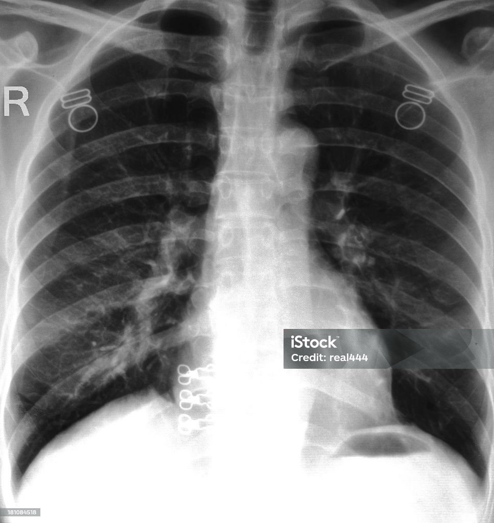 X-ray image de la poitrine. - Photo de Anatomie libre de droits