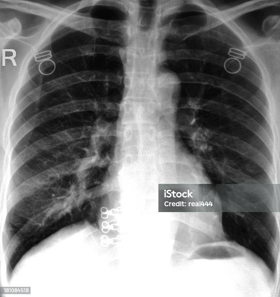 Radiografia Del Torace - Fotografie stock e altre immagini di Albero bronchiale - Albero bronchiale, Anatomia umana, Arto umano