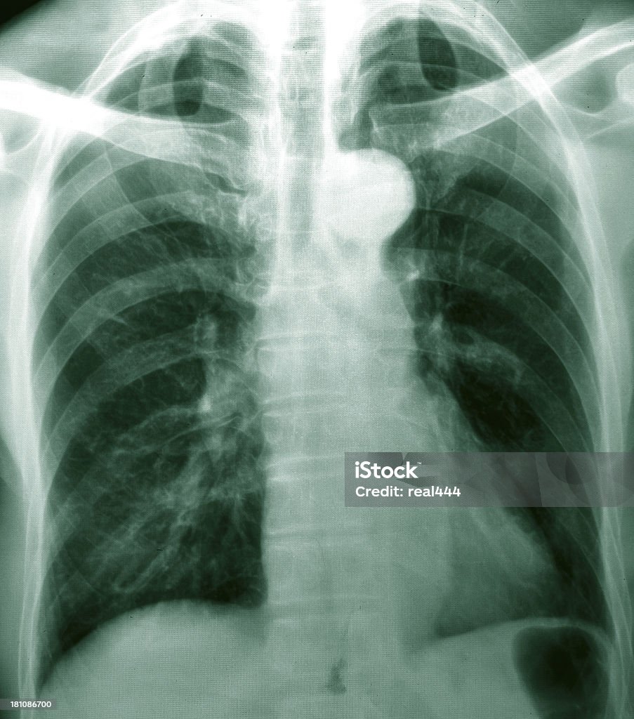 흉부 X-선 이미지 - 로열티 프리 X-레이 스톡 사진