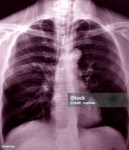 胸 X 線画像 - X線撮影のストックフォトや画像を多数ご用意 - X線撮影, イルミネーション, クローズアップ