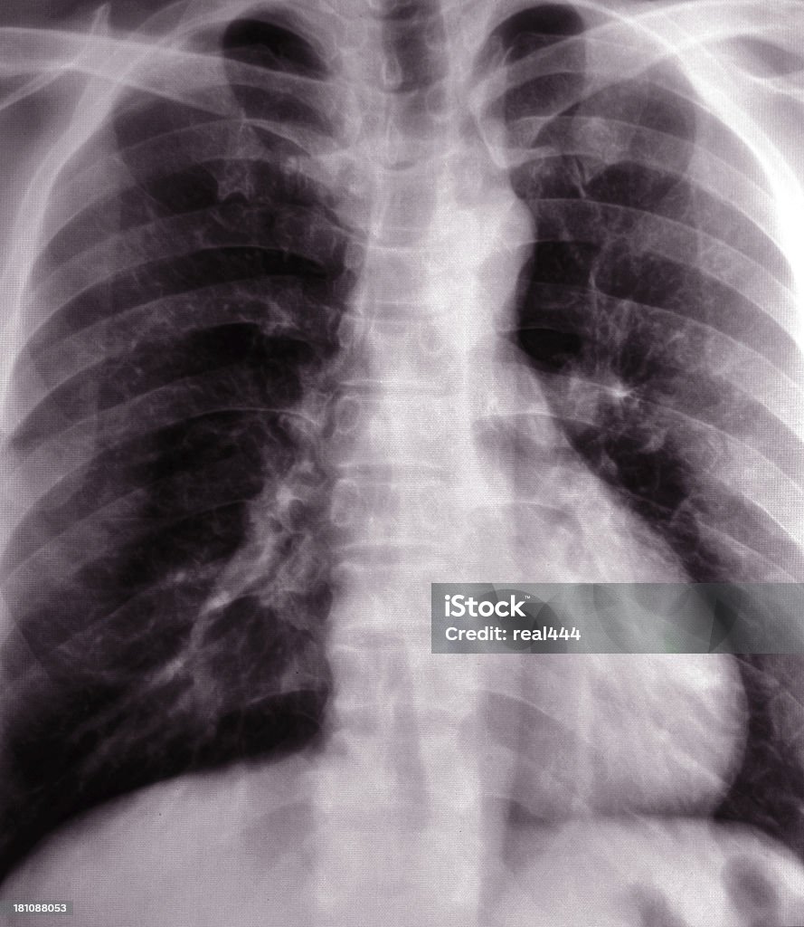 Рентгенография грудной клетки изображение - Стоковые фото Intercostal Space роялти-фри