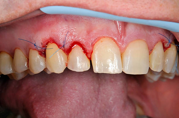 Gingivoplasty procedure Gingivoplasty procedure . Selective focus. gingivoplasty stock pictures, royalty-free photos & images