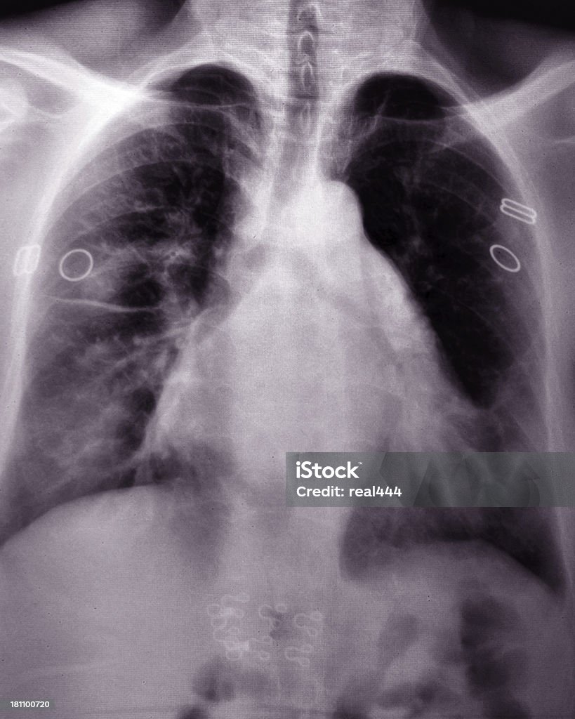 Una radiografía de tórax imagen - Foto de stock de Anatomía libre de derechos