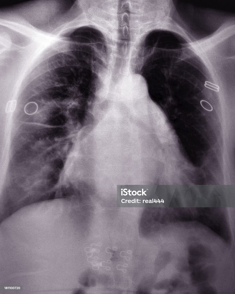 Chest X-ray image Anatomy Stock Photo