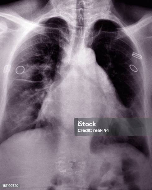 Chest Xray Image Stock Photo - Download Image Now - Anatomy, Animal Bone, Animal Rib Cage