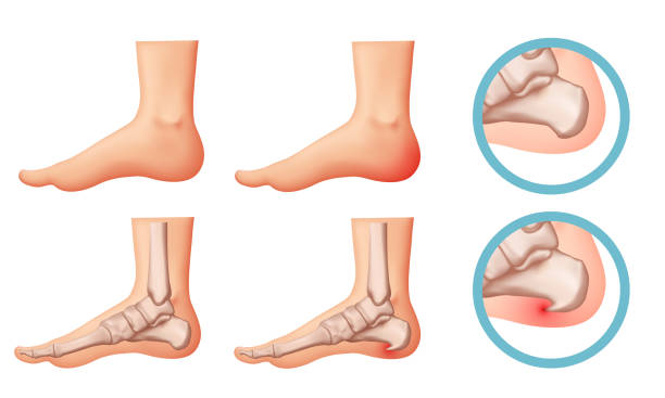 kuvapankkikuvitukset aiheesta kantapään kannuskuva. suunnitteluelementit plantaarifaskiitin teemasta. vektori asettaa. - kantaluu