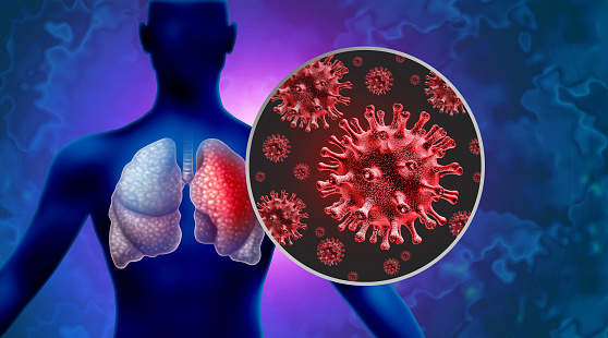 Pneumonia Outbreak Virus pathogen Lung Infection and Human lung infections or respiratory inflammation disease as influenza flu outbreak or pulmonary inflammatory illness.