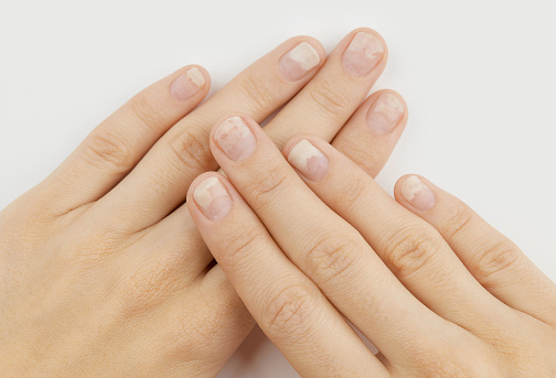 Fingernails with onycholysis after removing gel polish on grey background. Womans hands with damaged nails