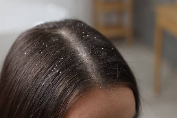 istock Woman with dandruff problem indoors, closeup. Space for text 1813697771