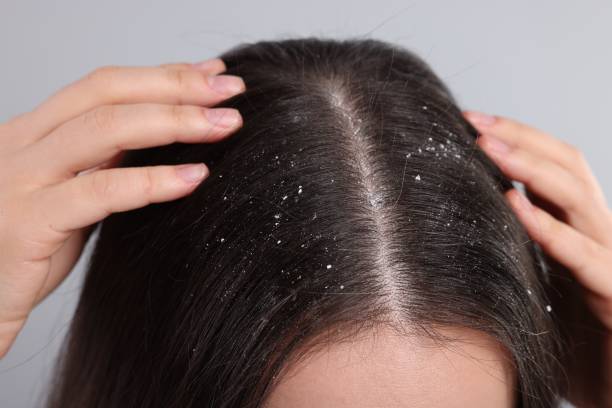 istock Woman with dandruff problem on grey background, closeup 1813698217