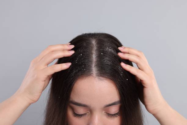 istock Woman with dandruff problem on grey background, closeup 1813698220