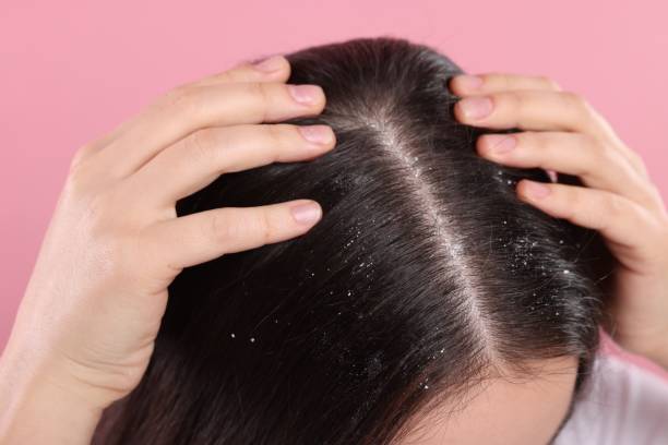 istock Woman with dandruff problem on pink background, closeup 1813698236