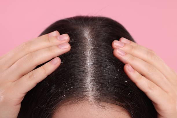 istock Woman with dandruff problem on pink background, closeup 1813699009