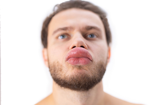 allergic reaction on the lip angioedema in a man, consequences of hyaluronic acid injections