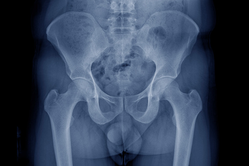 Film x-ray human's pelvis
