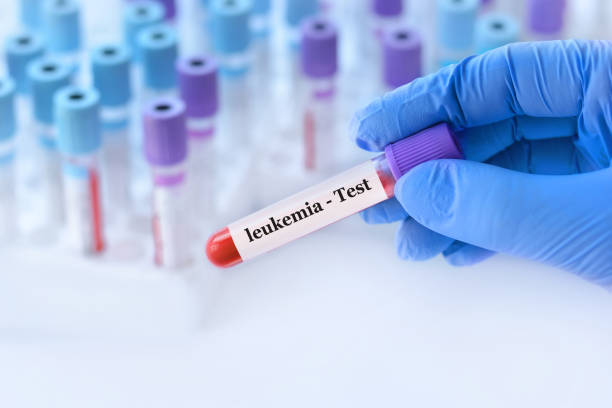 doctor holding a test blood sample tube with leukemia test on the background of medical test tubes with analyzes - blood red blood cell blood cell blood sample imagens e fotografias de stock