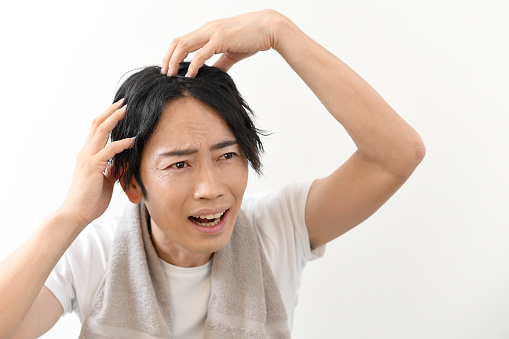 Asian man worrying about thinning hair while holding his head