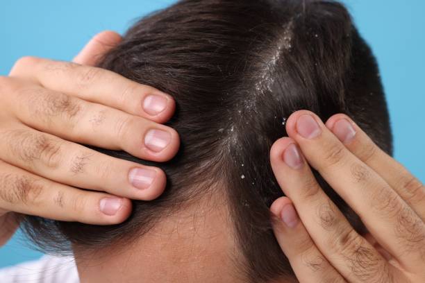 istock Man with dandruff in his dark hair on light blue background, closeup 1815469459