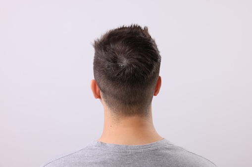 Man with dandruff in his dark hair on light grey background, back view