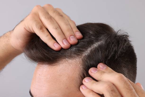 istock Man with dandruff in his dark hair on light grey background, closeup 1815469991