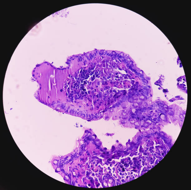 istock Terminal ileum ( colonoscopic biopsy). Lymphoid hyperplasia. Section show ileum mucosa, reveals hyperplastic lymphoid follicles. 1815902007