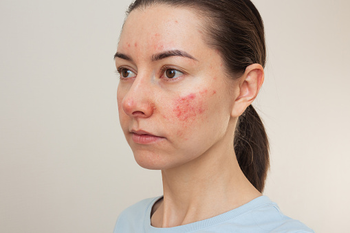 young Caucasian woman suffering from rosacea on her face in the acute stage. Dermatological problems.  isolated on a beige background. skin chronic disease